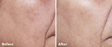 Load image into Gallery viewer, Home Microneedling .25 roller
