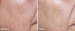 Home Microneedling .25 roller