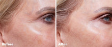 Load image into Gallery viewer, Home Microneedling .25 roller

