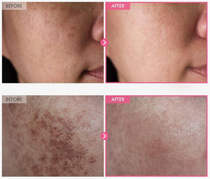 Arbutin 7% + Tranexamic Acid 4% Cream