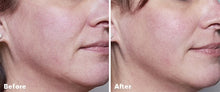 Load image into Gallery viewer, Home Microneedling .25 roller

