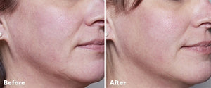 Home Microneedling .25 roller